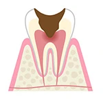 歯髄虫歯